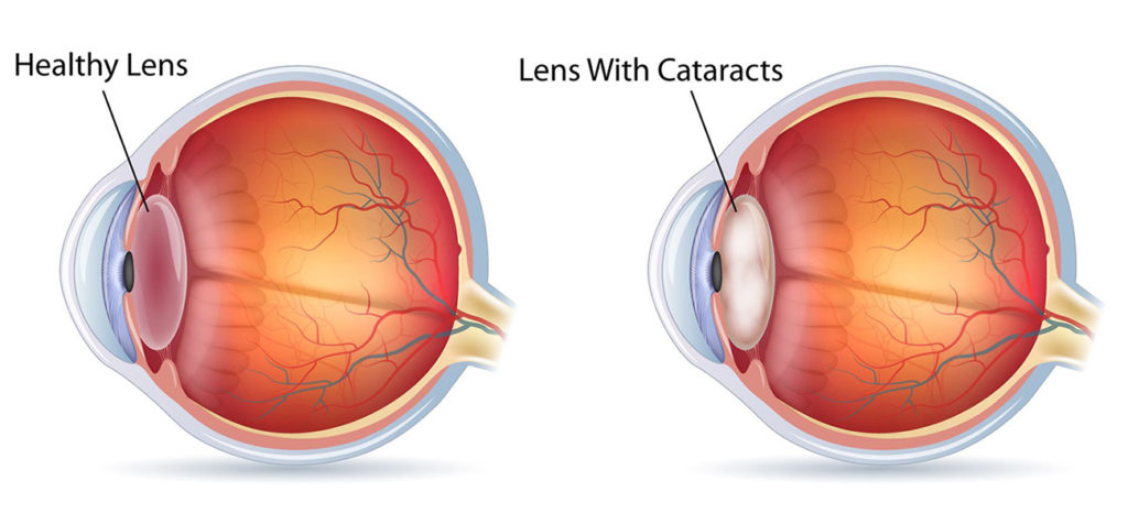 Cataracts Comparison Visual