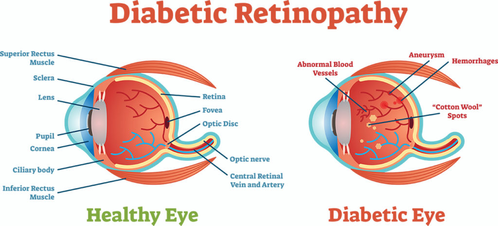 Diabetic Retinopathy Comparison Visual