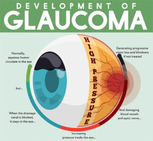 Development of Glaucoma Visual
