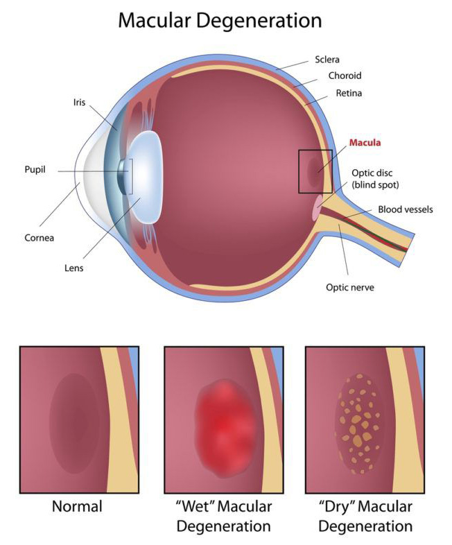Macular Degeneration Visual