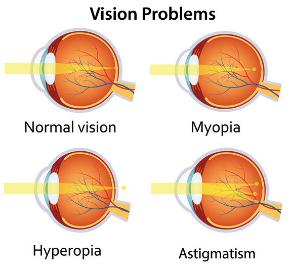 Vision Problems Comparison Chart